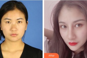 襄陽愛爾眼科醫(yī)院李紅莉整形價格表附眼部綜合案例展示