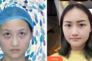 襄陽愛爾眼科醫(yī)院計虹整形價格表附激光去眼袋案例展示
