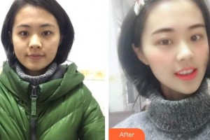 襄陽伊爾美整形美容醫(yī)院張月整形價格表附眼部綜合案例展示