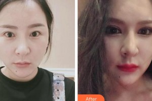 襄陽愛爾眼科醫(yī)院晉紅敏整形價格表附切開雙眼皮案例展示