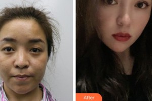 襄陽愛爾眼科醫(yī)院胡琴整形價格表附切開雙眼皮案例展示