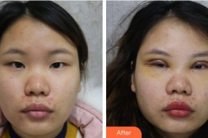 襄陽(yáng)愛爾眼科醫(yī)院呂雪婷整形價(jià)格表附眼部綜合案例展示