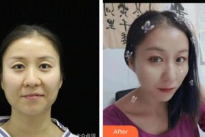 襄陽(yáng)愛爾眼科醫(yī)院朱琴整形價(jià)格表附眼部修復(fù)案例展示