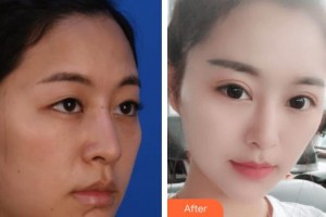 襄陽(yáng)愛爾眼科醫(yī)院秦光勇整形價(jià)格表附定點(diǎn)雙眼皮案例展示