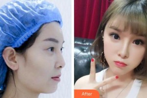 襄陽(yáng)愛爾眼科醫(yī)院文呈呈整形價(jià)格表附眼部綜合案例展示