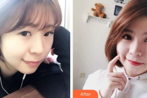 襄陽(yáng)愛爾眼科醫(yī)院楊賀斌整形價(jià)格表附切開雙眼皮案例展示