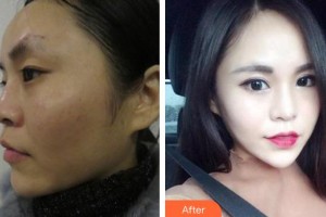 襄陽(yáng)愛爾眼科醫(yī)院黃蓋整形價(jià)格表附眼部綜合案例展示