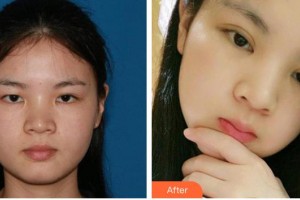 襄陽(yáng)愛爾眼科醫(yī)院鄭先芬整形價(jià)格表附切開雙眼皮案例展示