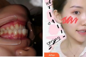 襄陽(yáng)牙牙口腔門診部陳建鋼整形價(jià)格表附金屬托槽矯正案例展示