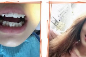 襄陽(yáng)牙牙口腔門診部夏海斌整形價(jià)格表附牙齒陶瓷矯正案例展示