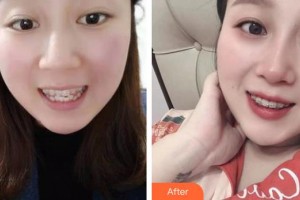 襄陽(yáng)牙牙口腔門診部胡彬潔整形價(jià)格表附隱形托槽矯正案例展示