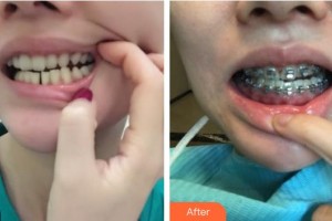 襄陽(yáng)佳潔口腔醫(yī)院胡毅整形價(jià)格表附金屬托槽矯正案例展示