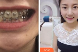 襄陽(yáng)佳潔口腔醫(yī)院付士杰整形價(jià)格表附金屬托槽矯正案例展示