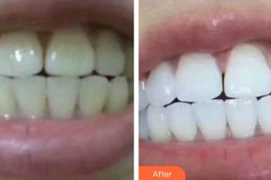 襄陽(yáng)牙牙口腔門診部楊坤整形價(jià)格表附美白貼片案例展示