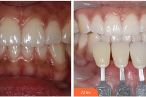 襄陽(yáng)維樂口腔門診部王東濤整形價(jià)格表附冷光美白案例展示