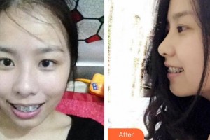 襄陽(yáng)市口腔醫(yī)院閆寒松整形價(jià)格表附金屬托槽矯正案例展示