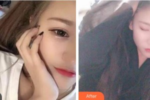 襄陽(yáng)市口腔醫(yī)院張德明整形價(jià)格表附牙貼面案例展示