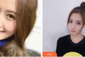 襄陽(yáng)市第一人民醫(yī)院李德勝整形價(jià)格表附埋線提升案例展示