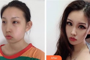 襄陽(yáng)市第一人民醫(yī)院劉羽整形價(jià)格表附熱瑪吉案例展示