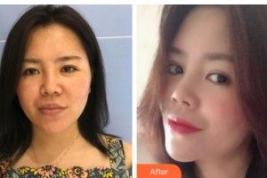 襄陽(yáng)市第一人民醫(yī)院王慧整形價(jià)格表附埋線提升案例展示