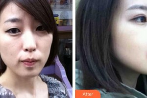 襄陽(yáng)市第一人民醫(yī)院劉剛整形價(jià)格表附埋線提升案例展示