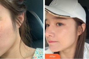 襄陽(yáng)市第一人民醫(yī)院陳勇整形價(jià)格表附激光美膚激光案例展示