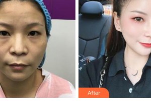 恩施中韓整形美容醫(yī)院陳海良整形價(jià)格表附肋軟骨隆鼻案例展示