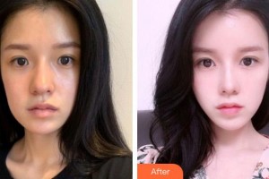 恩施華美整形美容門診部謝雙靈整形價(jià)格表附鼻部綜合案例展示