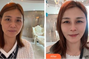 恩施華美整形美容門診部高海燕整形價(jià)格表附肋軟骨隆鼻案例展示