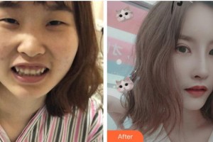 恩施愛爾眼科醫(yī)院戴守整形價(jià)格表附眼部綜合案例展示