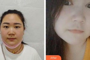 恩施華美整形美容門(mén)診部韓金柱整形價(jià)格表附切開(kāi)雙眼皮案例展示