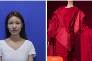 恩施慧益眼科醫(yī)院蘆曉磊整形價(jià)格表附上眼瞼去脂案例展示