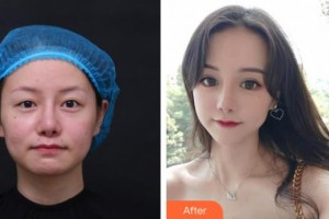 恩施慧益眼科醫(yī)院鮮光軍整形價(jià)格表附眼部綜合案例展示