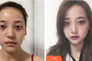 恩施慧益眼科醫(yī)院包煜芝整形價(jià)格表附眼部綜合案例展示