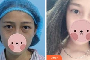 恩施慧益眼科醫(yī)院肖紫云整形價(jià)格表附內(nèi)切祛眼袋案例展示