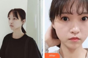 恩施慧益眼科醫(yī)院楊方列整形價(jià)格表附切開(kāi)雙眼皮案例展示