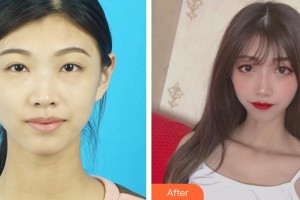 恩施慧益眼科醫(yī)院周瑜整形價(jià)格表附內(nèi)切祛眼袋案例展示