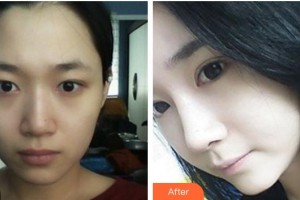 恩施慧益眼科醫(yī)院程揚(yáng)整形價(jià)格表附切開(kāi)雙眼皮案例展示