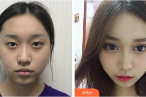 恩施慧益眼科醫(yī)院李新宇整形價(jià)格表附眼部綜合案例展示