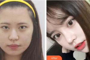 恩施慧益眼科醫(yī)院賀濤整形價(jià)格表附埋線雙眼皮案例展示