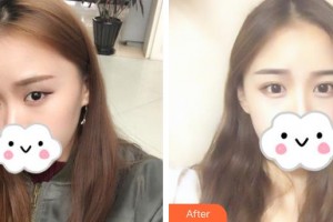 恩施慧益眼科醫(yī)院范凌志整形價(jià)格表附眼部綜合案例展示