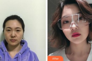 仙桃憶美醫(yī)療美容門(mén)診部高峽整形價(jià)格表附埋線提升案例展示