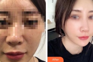 仙桃友好醫(yī)學(xué)美容醫(yī)院胡霜紅整形價(jià)格表附埋線提升案例展示