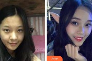 仙桃友好醫(yī)學(xué)美容醫(yī)院吳小蔚整形價(jià)格表附膠原蛋白除皺案例展示