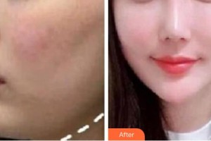 仙桃憶美醫(yī)療美容門(mén)診部熊一頻整形價(jià)格表附埋線提升案例展示