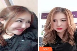 仙桃友好醫(yī)學(xué)美容醫(yī)院張志翔整形價(jià)格表附嗨體去頸紋案例展示