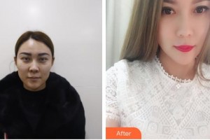 仙桃博美醫(yī)療美容醫(yī)院王英明整形價(jià)格表附埋線提升案例展示