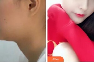 仙桃博美醫(yī)療美容醫(yī)院雷文斌整形價(jià)格表附埋線提升案例展示