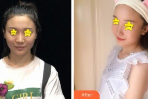 仙桃憶美醫(yī)療美容門(mén)診部解永學(xué)整形價(jià)格表附埋線提升案例展示