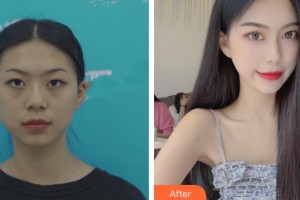 仙桃愛(ài)爾眼科醫(yī)院何碧華整形價(jià)格表附眼部綜合案例展示